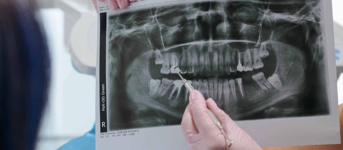 wisdom tooth removal